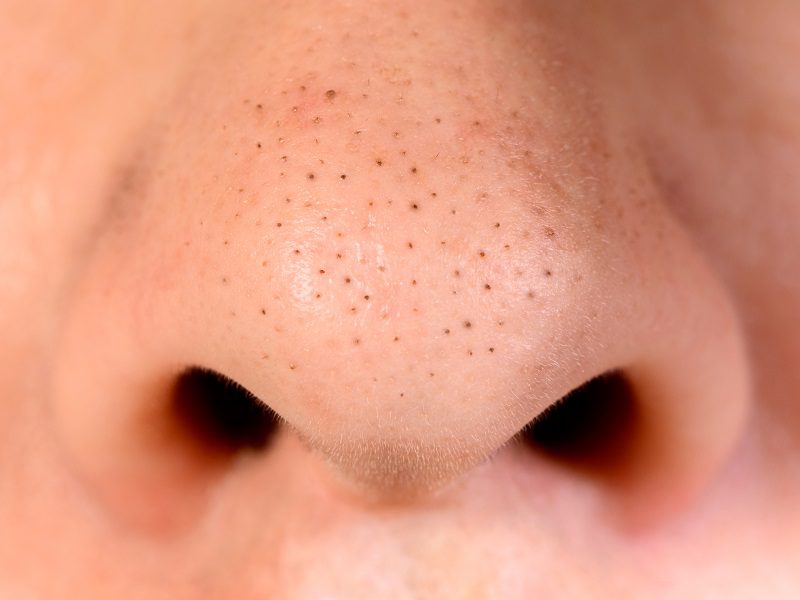 How-To-Remove-Blackheads-at-Home