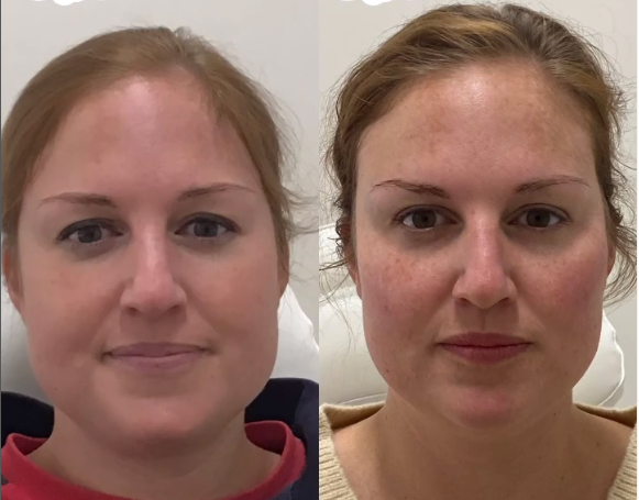 Face slimming exercises